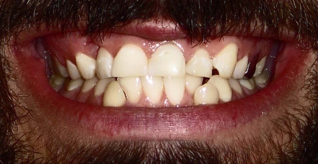Professional Whitening — before