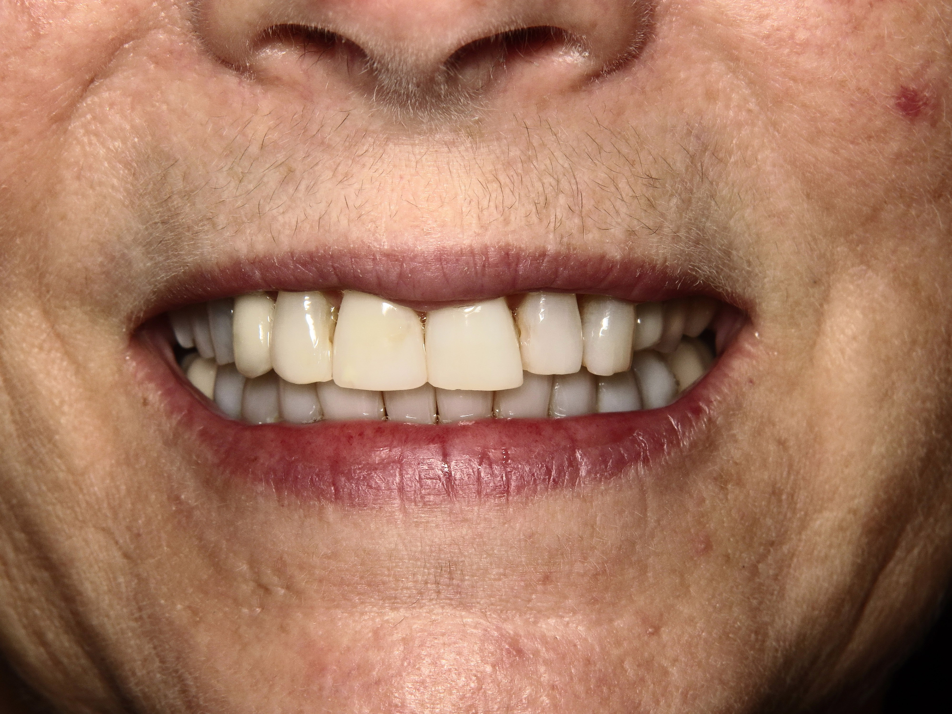 Smile Alignment — before
