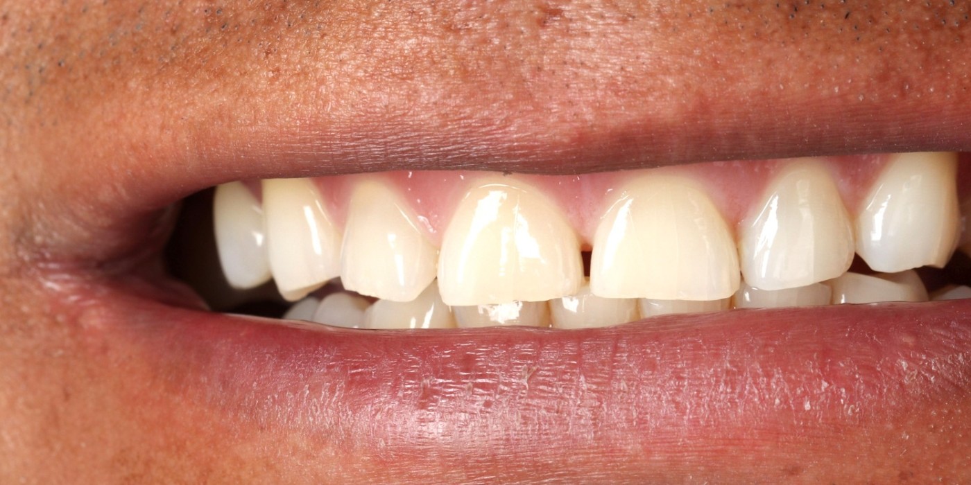 Professional Whitening - before