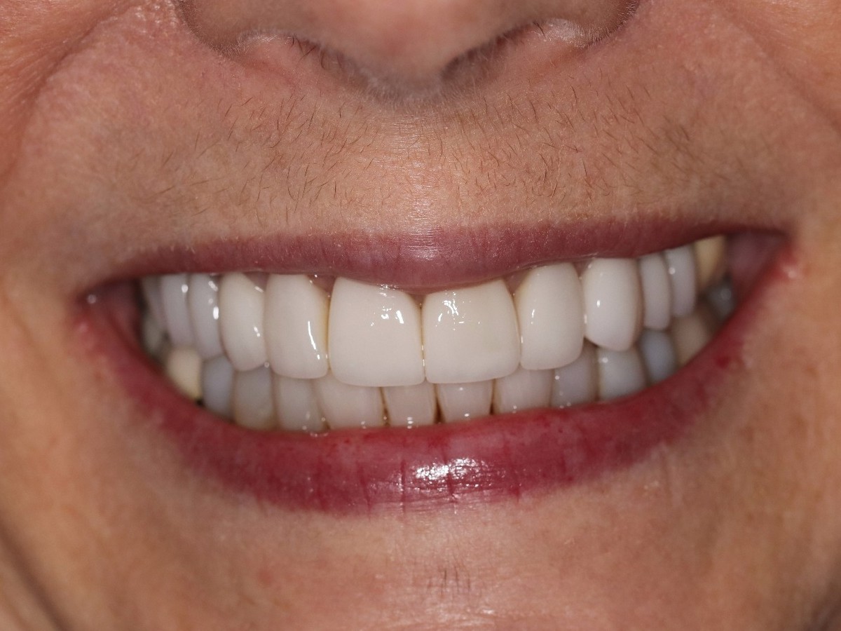 Smile Alignment - after