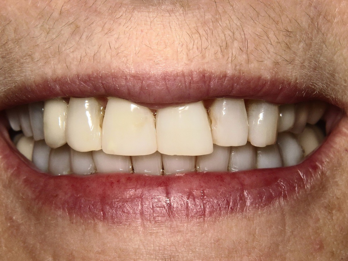 Smile Alignment - before