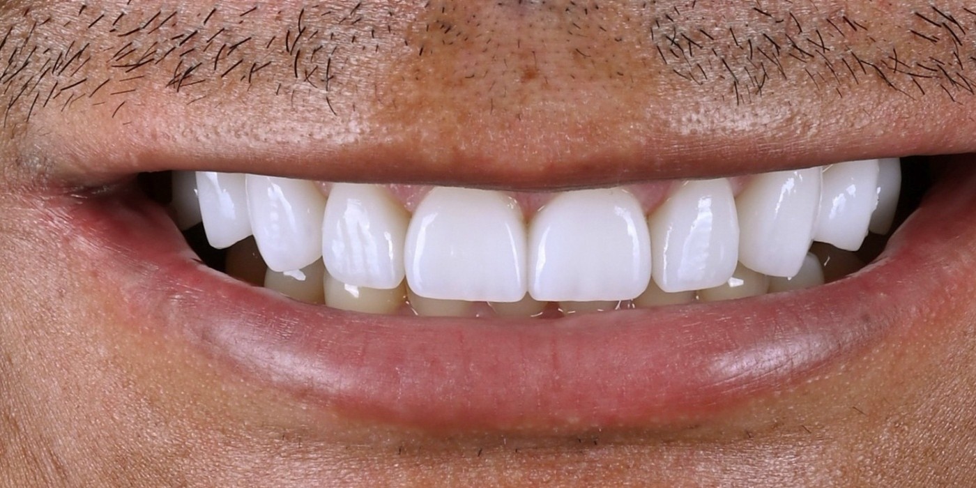 Professional Whitening - after