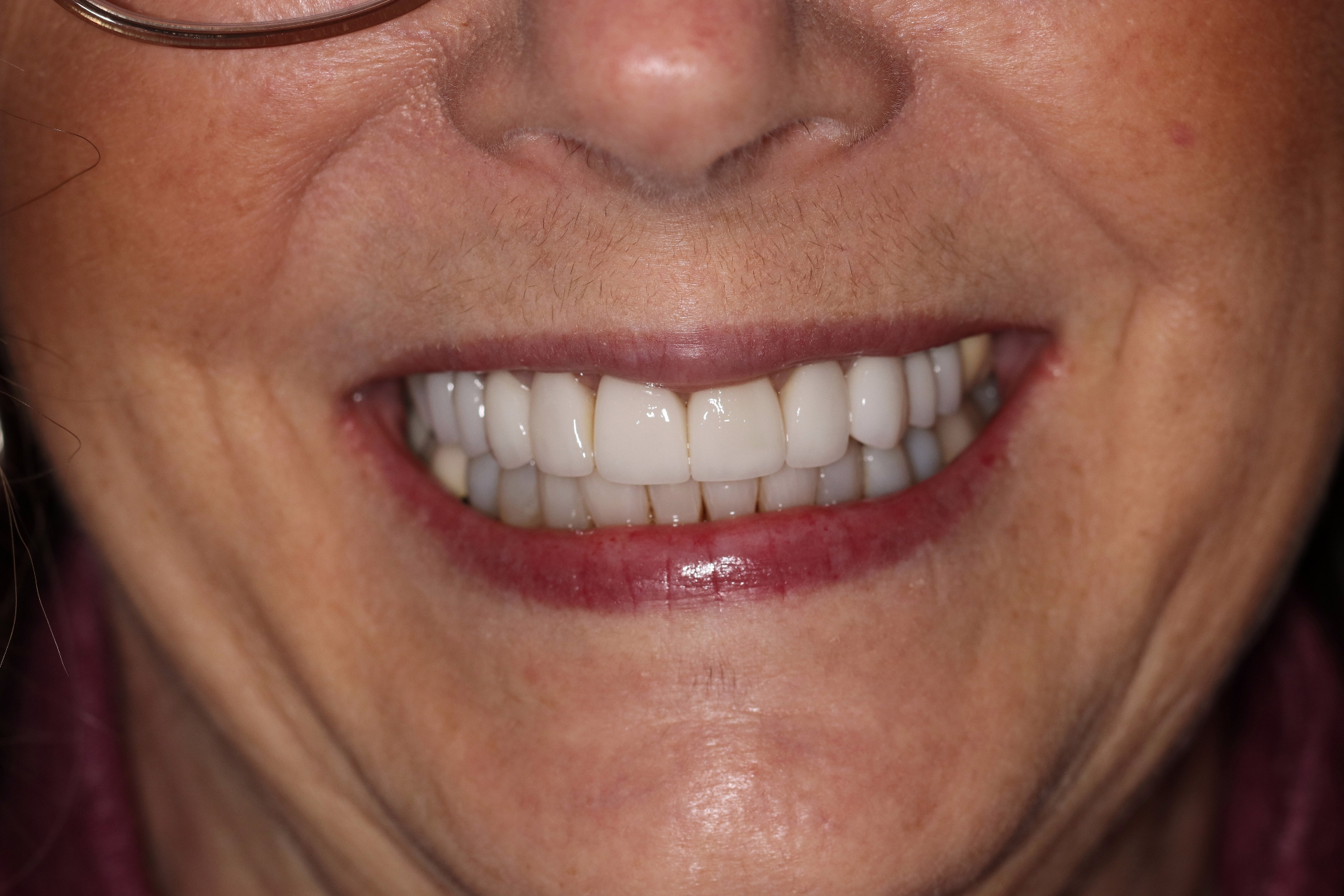 Smile Alignment — after