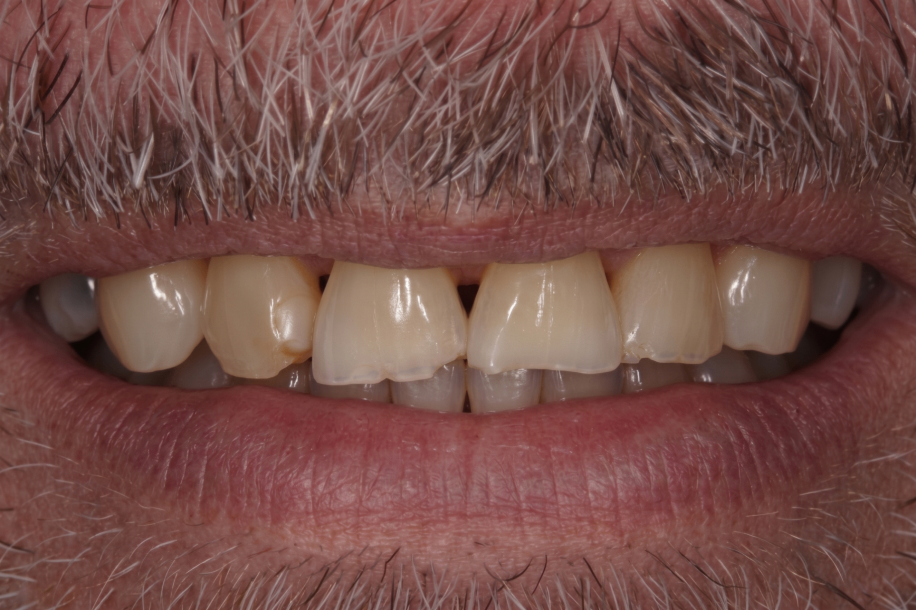 Porcelain Veneers - before